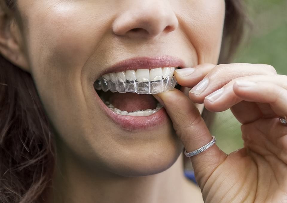 InvisalignGO – transparente Zahnspangen